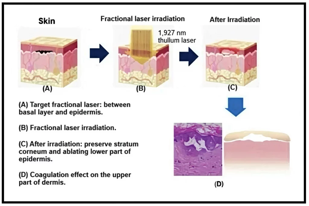 A revolution in skin rejuvenation and regeneration without a long recovery period!