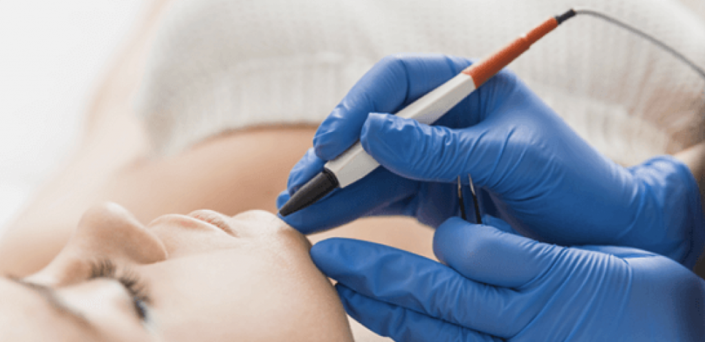 Do you dream of perfectly smooth skin – without irritation, ingrown hairs and constant shaving? Discover electrolysis – the most accurate and effective method of permanent hair removal, which works on all hair types, even light and grey hair. This treatment is for women and men who value perfection and long-lasting results.