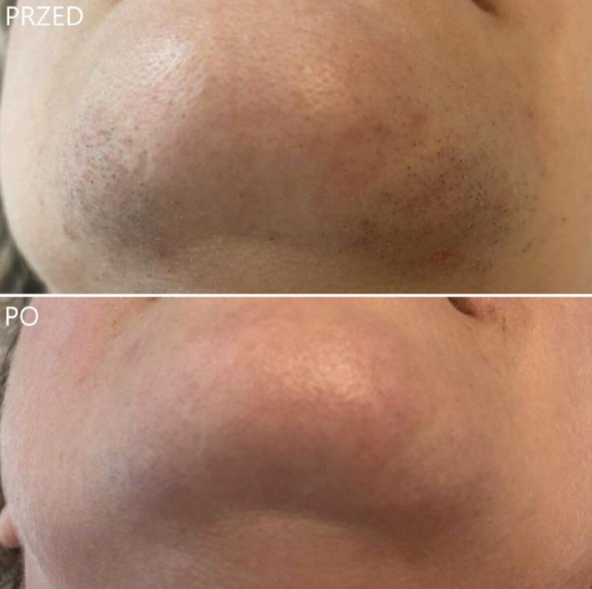 ELECTROLYSIS – permanent hair removal