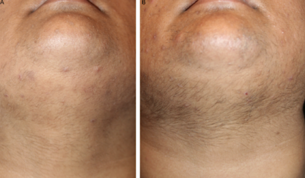 ELECTROLYSIS – permanent hair removal