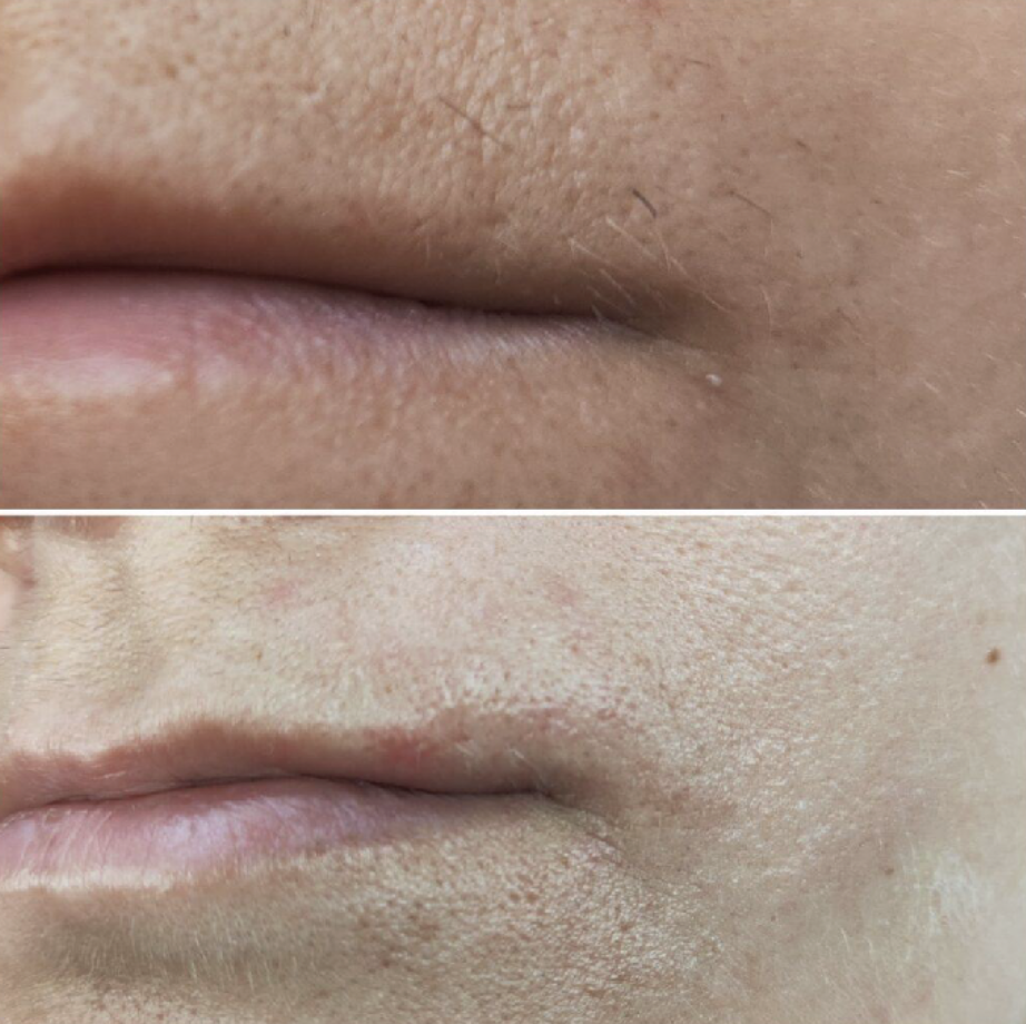 ELECTROLYSIS – permanent hair removal