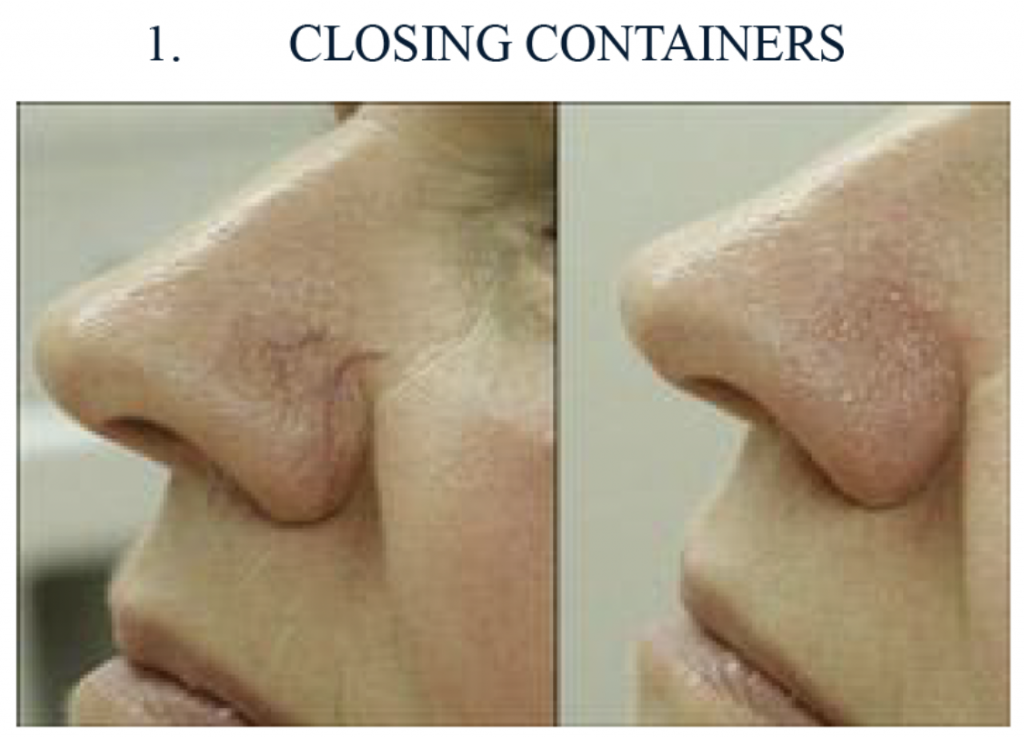 At Simply Beauty, we understand the importance of flawless skin without discolouration, warts or visible capillaries. That is why we offer electrocoagulation – a treatment that safely and precisely removes unwanted lesions, revealing beautiful, healthy and radiant skin. It is a subtle correction, but the effect can be stunning!