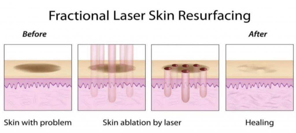 CO₂ FRACTIONAL LASER