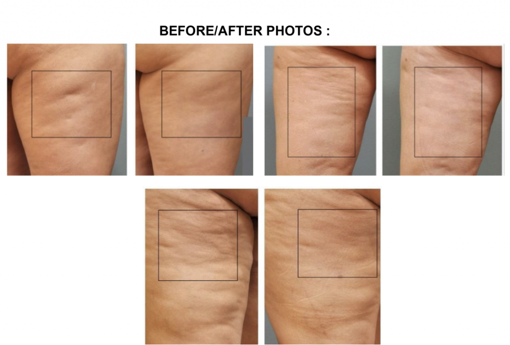 CO₂ FRACTIONAL LASER