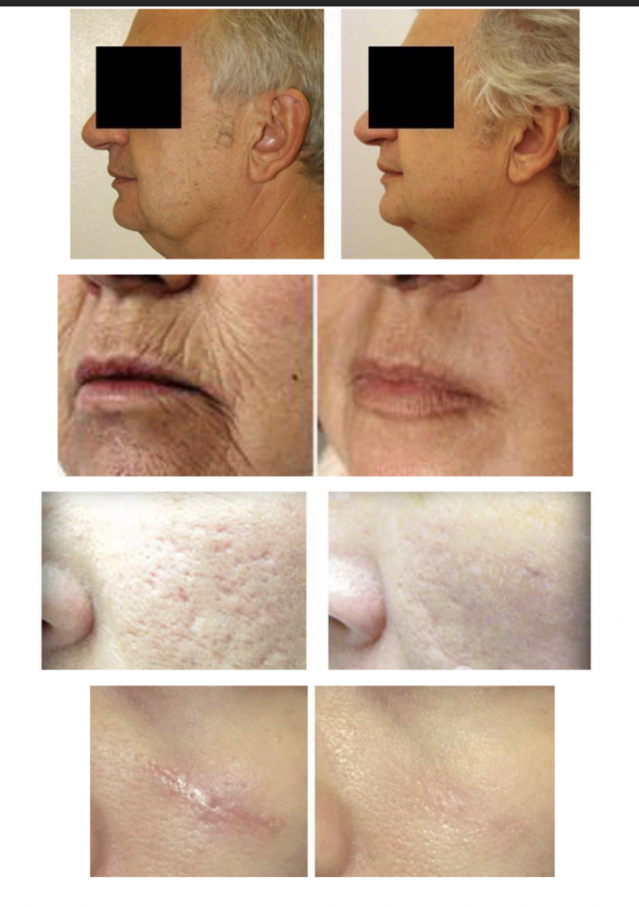 CO₂ FRACTIONAL LASER