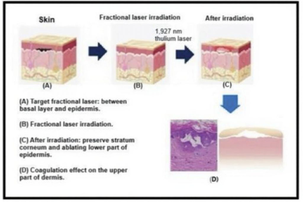 TULUS LASER – NEW AT SIMPLY BEAUTY