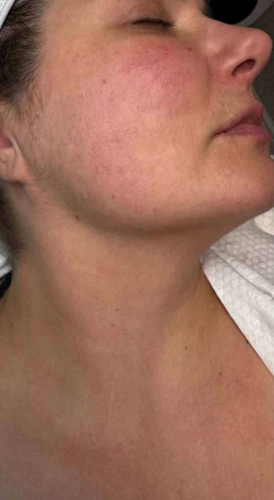 How the skin looks like after thulium laser procedure - Chiswick