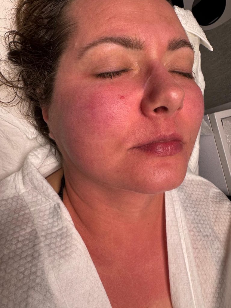 How the skin looks like after thulium laser procedure - Chiswick